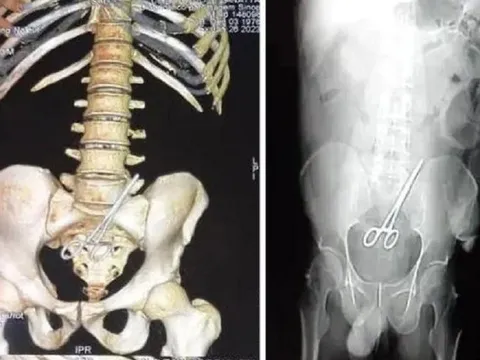 Bác sĩ bỏ quên kéo trong bụng bệnh nhân khiến người này "đứng ngồi không yên"