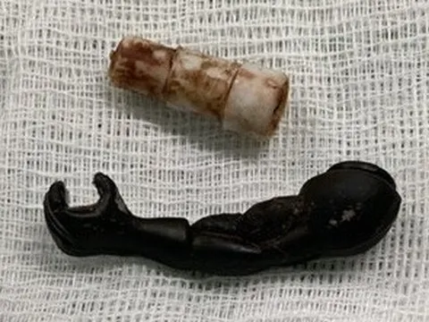 Lấy 2 dị vật trong vùng kín bé gái 5 tuổi