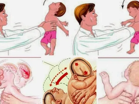 Bé 4 tháng tuổi bị chảy máu não nghi do bị chuyền tay nhau bế và rung lắc