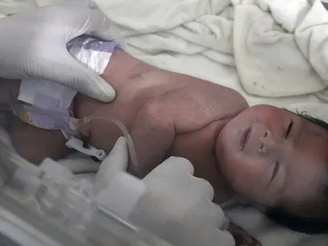 Bé gái Syria chào đời trong đống đổ nát của tòa nhà bị sập, dây rốn vẫn nối với bánh nhau trong bụng mẹ