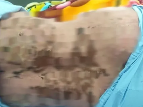 Dùng thuốc nam chữa đau khớp không rõ nguồn gốc, người phụ nữ suýt mất mạng