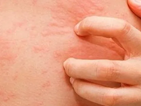 Vì sao bệnh ngoài da tăng mạnh do nồm ẩm?