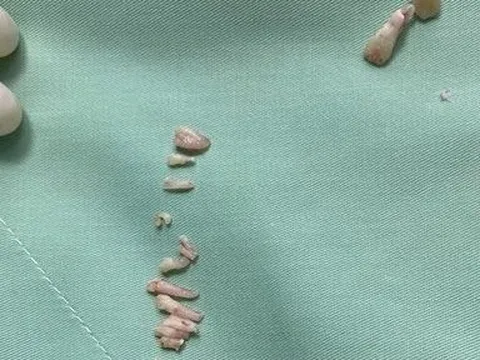 Bác sĩ mổ khối u "quái" phát hiện 30 chiếc răng bên trong