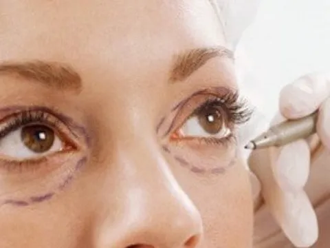 Bờ mi dưới lật ngửa, mắt không khép được sau khi đi cắt mí