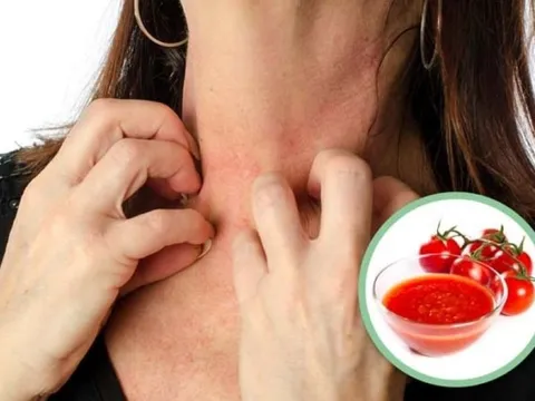 Những kiểu ăn cà chua dễ dẫn tới ngộ độc, cần tránh xa