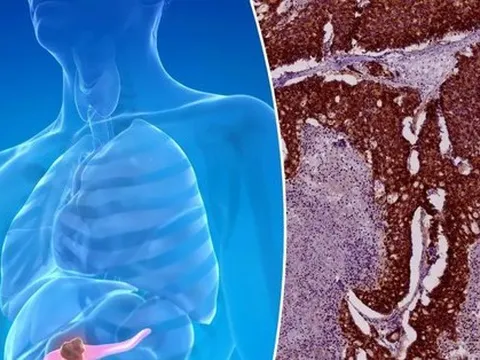 Tỷ lệ tử vong vì ung thư tuyến tụy tăng nhanh ở phụ nữ dưới 55 tuổi