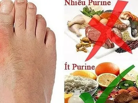 7 thực phẩm mà người mắc bệnh gout nên tránh xa