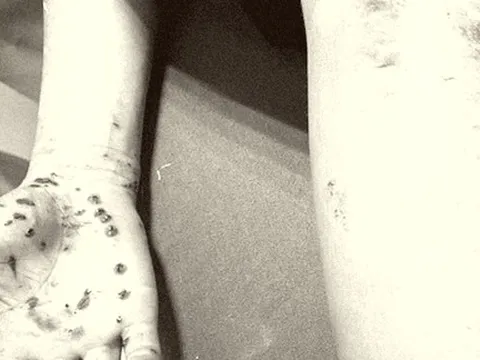 Nhập viện cấp cứu vì điện thoại phát nổ khi vừa dùng vừa sạc pin