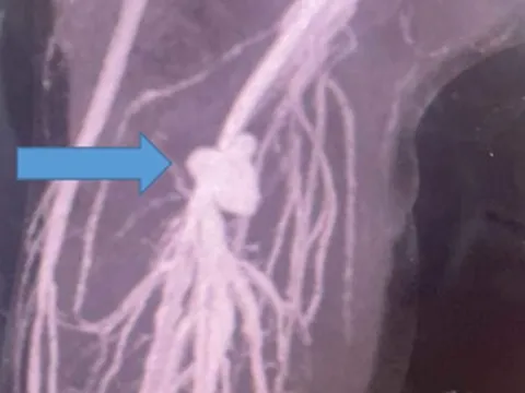 Bị kéo đâm vào chân khi đang chơi, bé trai suýt phải cắt chân