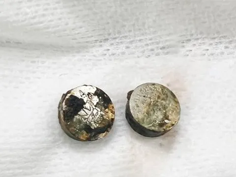 Lấy pin bị cháy khét trong mũi bé gái 6 tuổi