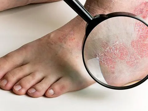 Chân phù nề không đi nổi sau khi tự ý dùng thuốc suốt 1 năm