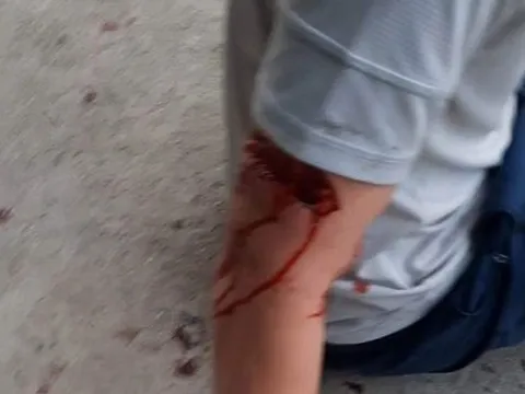 Nha Trang chỉ đạo xử lý vụ chó cắn du khách nước ngoài nhập viện