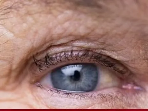 6 dấu hiệu cảnh báo đột quỵ sắp xảy ra trước một tuần