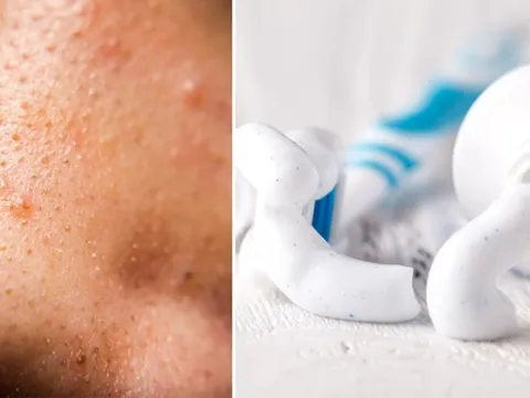 Da mặt tổn thương nghiêm trọng vì dùng kem đánh răng trị mụn theo Tiktok