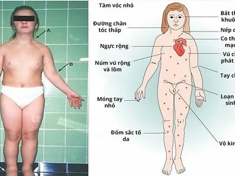 Thấy con thấp hơn bạn cùng trang lứa, đưa đi khám phát hiện mắc hội chứng Turner