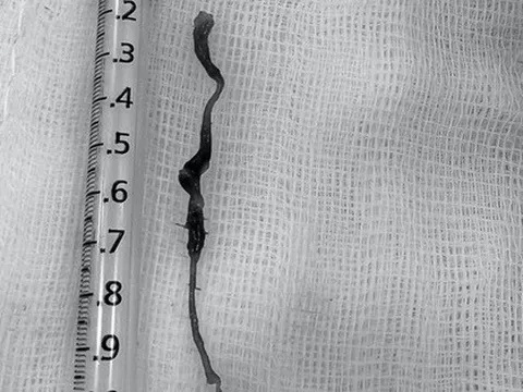 "Cả tấc" máu đông rút ra từ người đàn ông hút thuốc lá