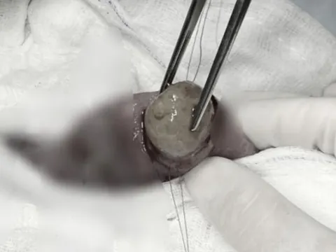 Cảnh báo nguy hiểm khi trẻ nuốt đồ chơi hạt nở