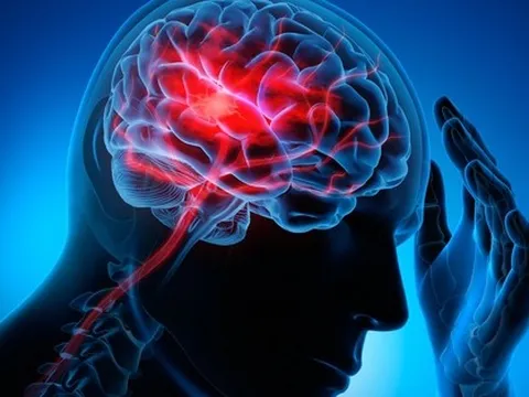 1 dấu hiệu của đột quỵ có thể xảy ra trước đó 90 ngày