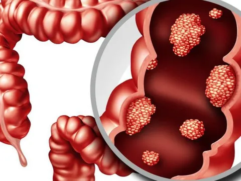 2 dấu hiệu hàng đầu của ung thư đại tràng và những đối tượng dễ mắc