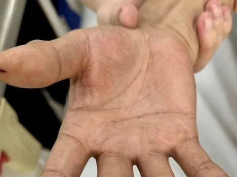 Đột quỵ não không đến bệnh viện, người nhà chích máu ngón tay khiến người đàn ông suýt chết