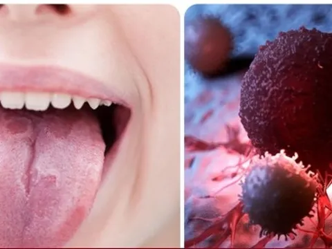 Dấu hiệu ung thư lưỡi giai đoạn đầu