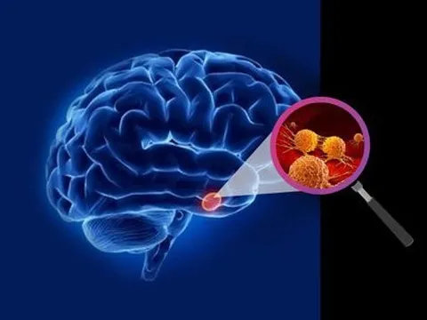 Dấu hiệu đầu tiên khi thức dậy vào buổi sáng báo hiệu khối u não