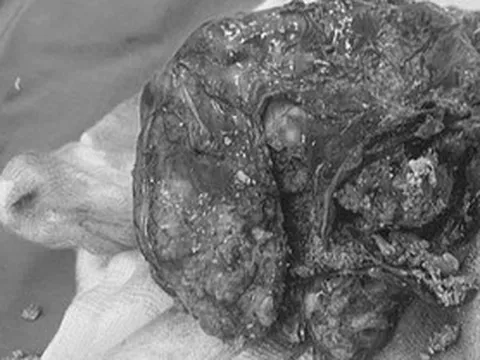 Ho nhiều, khó thở, cô gái 18 tuổi phát hiện điều 'khủng khiếp' ở lồng ngực