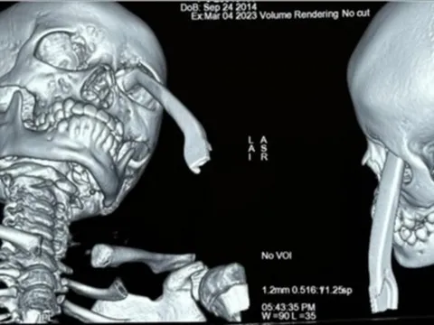 Hai bệnh viện báo động đỏ cùng cứu bé gái bị tay thắng xe đạp đâm hốc mắt