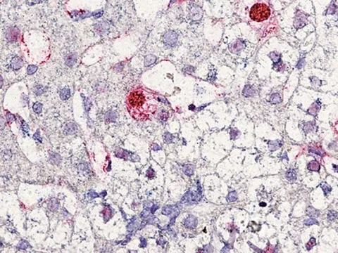 Phát hiện virus mới gây bệnh viêm gan ở người