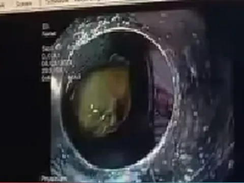 Sản phụ suýt mất mạng do nuốt mật lợn