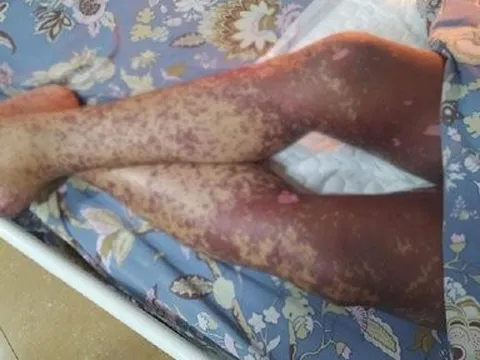 Suýt mất mạng do tự uống thuốc không rõ nguồn gốc