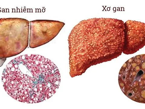 Gan nhiễm mỡ có gây ung thư?