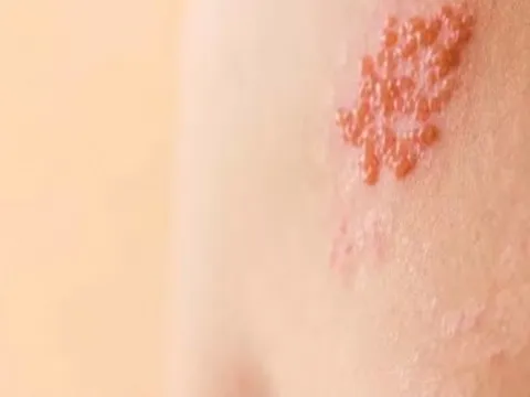 Sự thật về bệnh zona tuyệt đối không nên bỏ qua