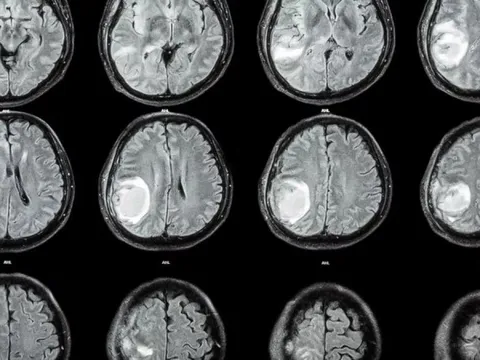 Đầu bé 1 tuổi tự nhiên to lên, bác sĩ lấy ra cả một bào thai trong não