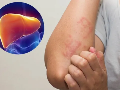 Bị viêm gan B nhưng không đi khám thường xuyên, lúc bệnh nặng mới phát hiện đã bị ung thư