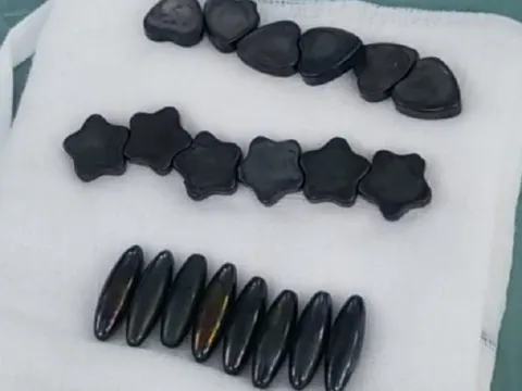 Bé trai 10 tuổi nuốt 20 viên nam châm vì tưởng là kẹo ngọt
