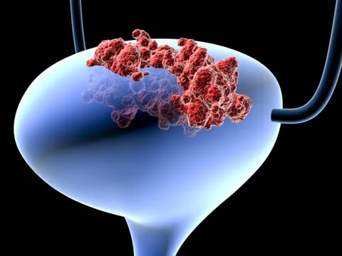 Đột phá: Xét nghiệm nước tiểu dự báo ung thư 12 năm trước khi phát bệnh