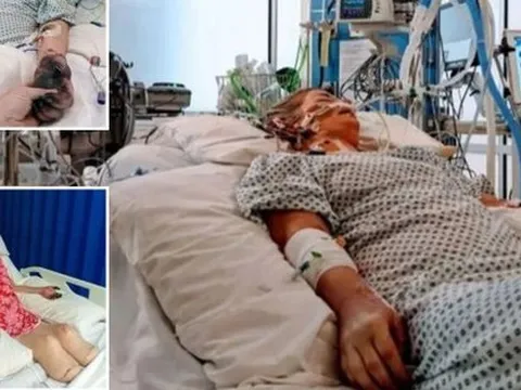 Người phụ nữ phải bỏ 2 chân và ngón tay vì căn bệnh triệu chứng giống cúm nhưng nguy hiểm gấp nhiều lần