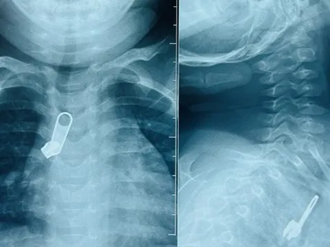 Móc khóa 'đi lạc' vào phế quản bé trai vì sai lầm của người lớn