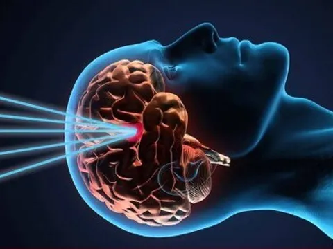 Dấu hiệu u não ác tính