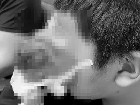 Cậu bé 4 tuổi bị u 'quái' che nửa vùng mặt, lúc nào cũng đau đớn, sợ hãi