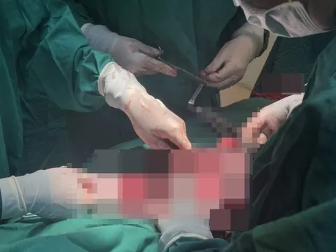 Đắk Lắk: Lần đầu tiên phẫu thuật thành công bướu giáp thòng hiếm gặp