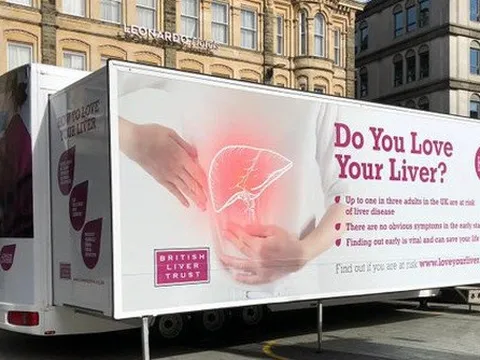 Sáng kiến xe tải di động tầm soát ung thư gan tại Anh