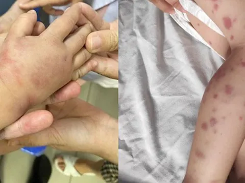 Trẻ 41 tháng tuổi phù nề, bầm tím tay chân vì nguyên nhân không ngờ