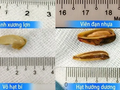 Bác sĩ hướng dẫn sơ cứu hóc dị vật