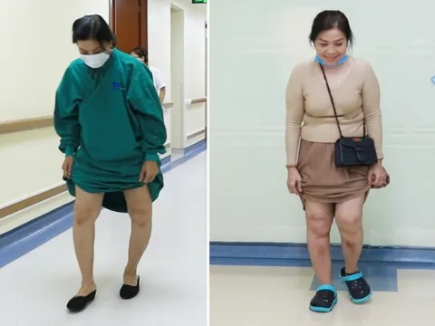 Mặc cảm vì chân vòng kiềng nặng, người phụ nữ hạnh phúc khi được đi thẳng như bao người