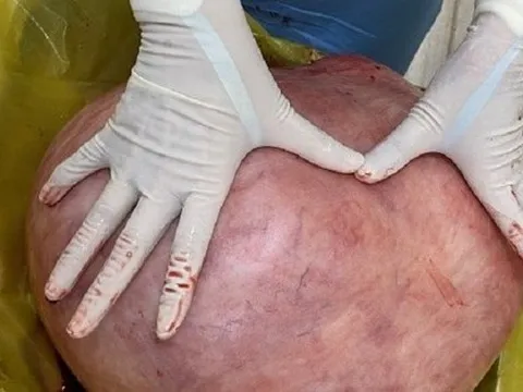 Nữ bệnh nhân nhiều năm mang u quái khổng lồ 11 kg vì nghĩ... mình mập