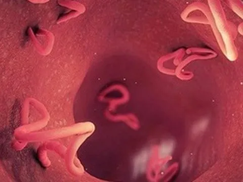 Dấu hiệu nhiễm giun sán: Ai đam mê ăn rau sống, các loại gỏi càng phải đề phòng