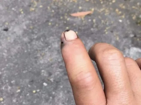 Bị rắn cắn, người đàn ông ôm theo đầu rắn vào bệnh viện cấp cứu