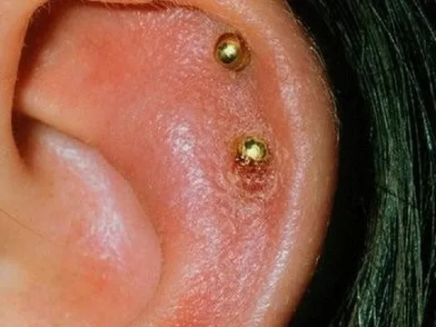 Nữ sinh bị biến dạng tai sau khi bấm lỗ tai